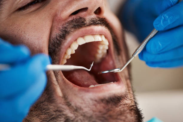 Best Emergency Tooth Extraction in Slaughterville, OK
