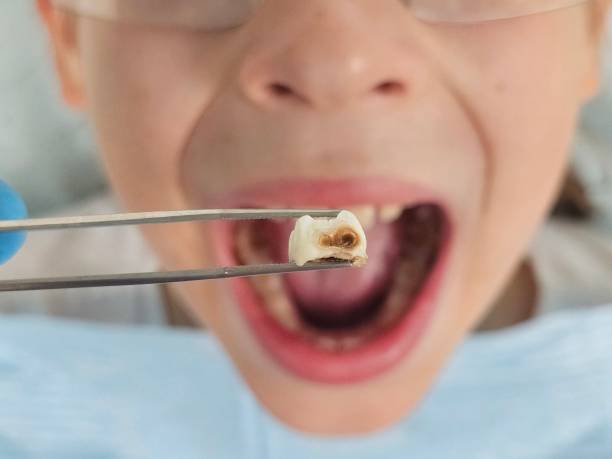 Best Emergency Tooth Extraction in Slaughterville, OK